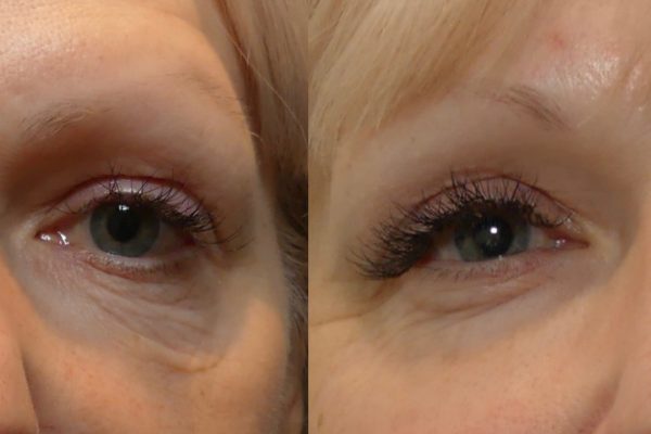 Morpheus8 Treatment before and after | Coral Springs Med Spa in Coral Springs, FL