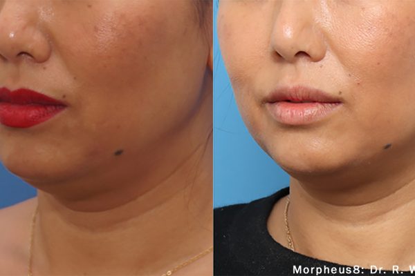 Morpheus8 Treatment before and after | Coral Springs Med Spa in Coral Springs, FL