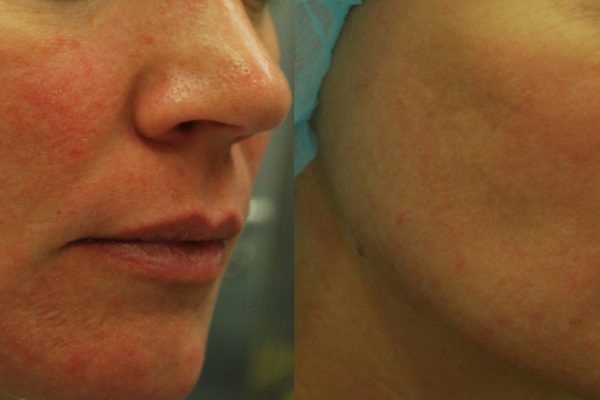 Morpheus8 Treatment before and after | Coral Springs Med Spa in Coral Springs, FL