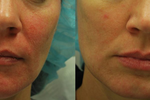 Morpheus8 Treatment before and after | Coral Springs Med Spa in Coral Springs, FL