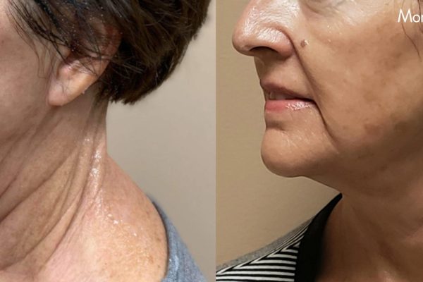 Morpheus8 Treatment before and after | Coral Springs Med Spa in Coral Springs, FL