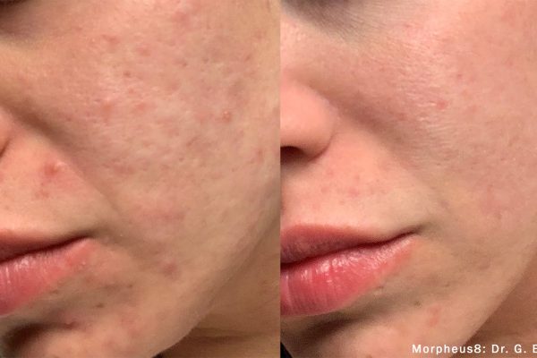 Morpheus8 Treatment before and after | Coral Springs Med Spa in Coral Springs, FL