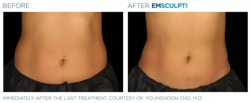 Emsculpt_Neo_PIC_Ba-card-female-lateral-abdomen-150_ENUS100-scaled