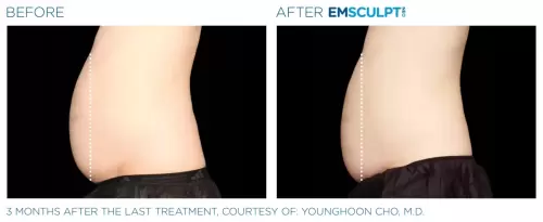 Emsculpt_Neo_PIC_Ba-card-male-lateral-abdomen-147_ENUS100-scaled