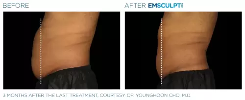 Emsculpt_Neo_PIC_Ba-card-male-lateral-abdomen-148_ENUS100-scaled